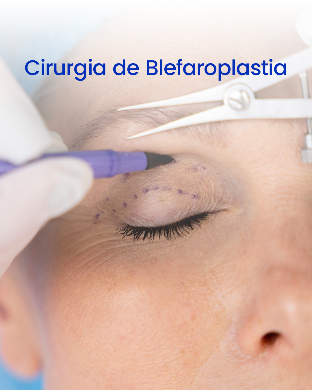 Cirurgia de Blefaroplastia
