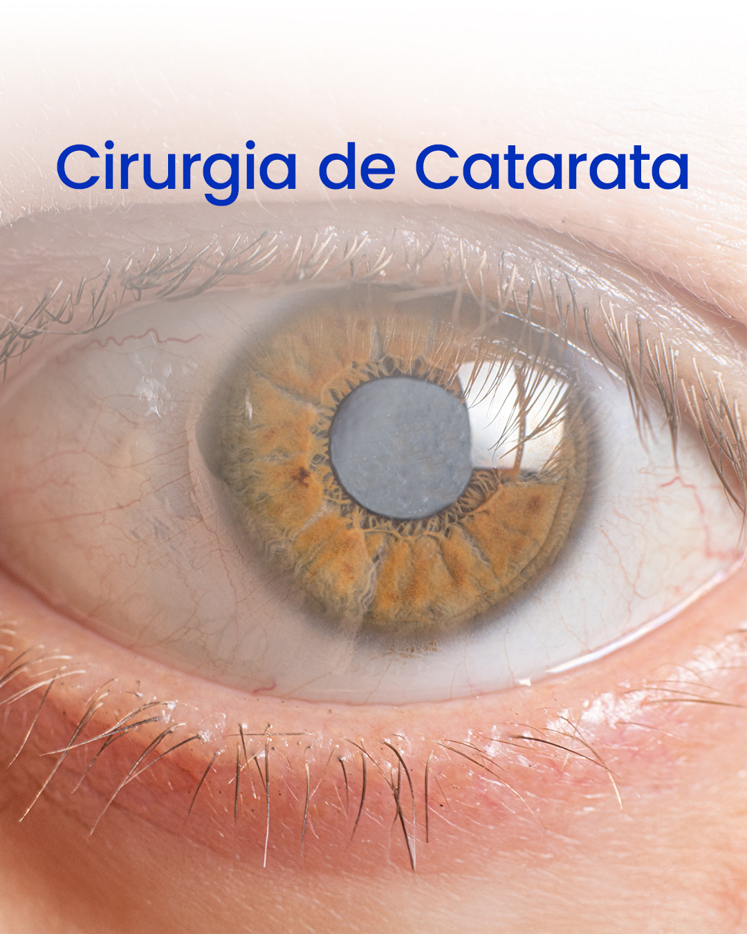 Cirurgia de Catarata