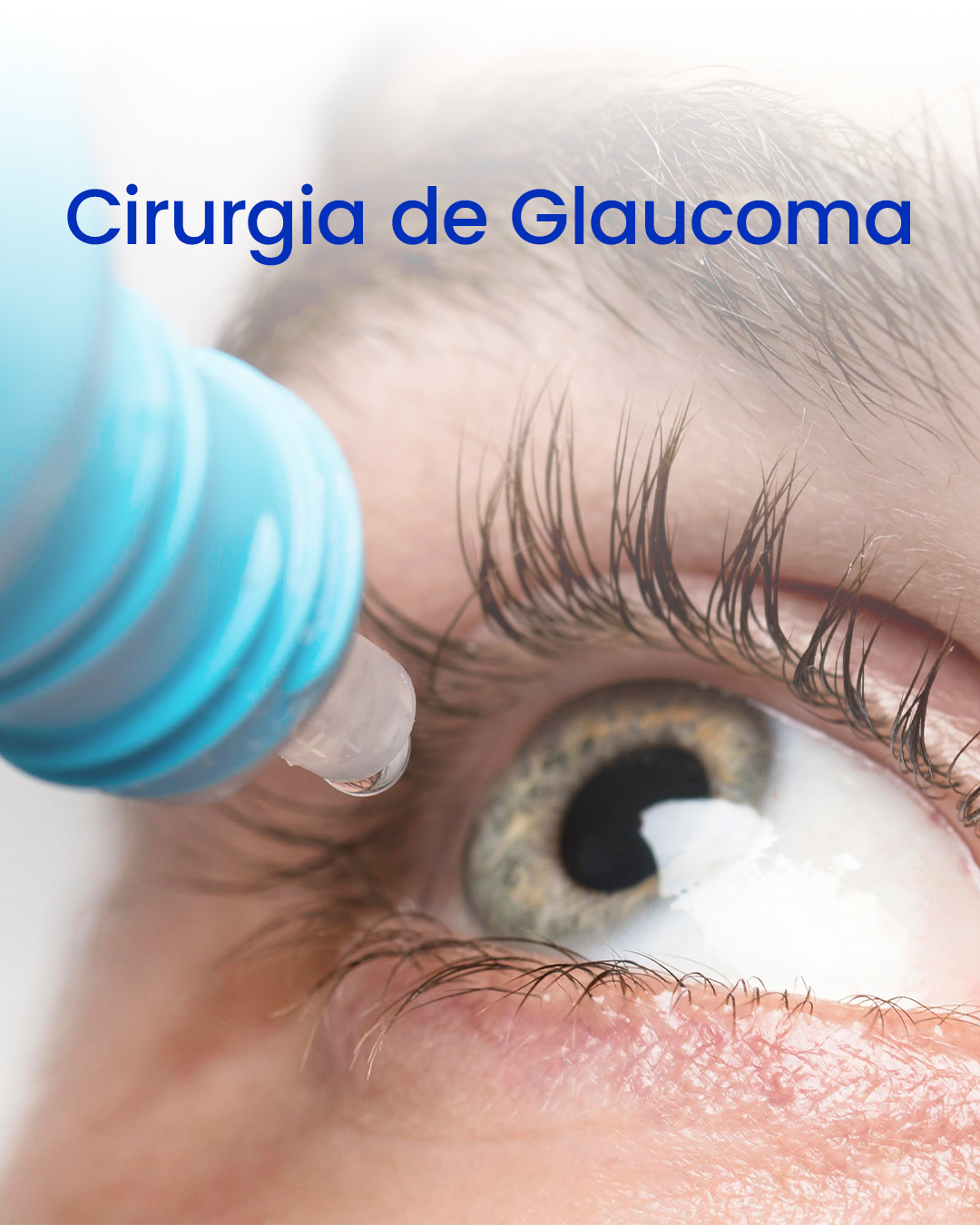 Cirurgia de Glaucoma