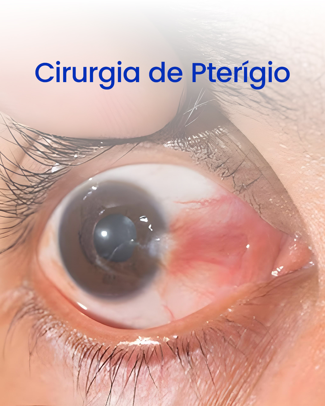 Cirurgia de Pterígio