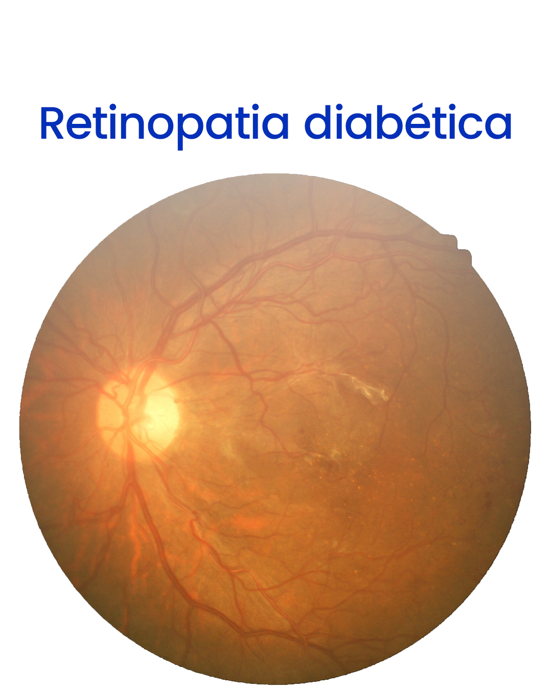 Retinopatia diabética - V2